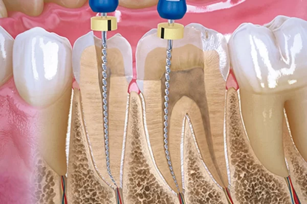 endodoncia